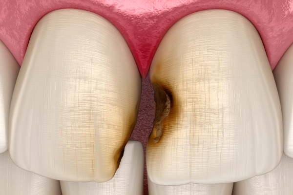 Central incisor teeth damaged by caries. Medically accurate tooth 3D illustration.